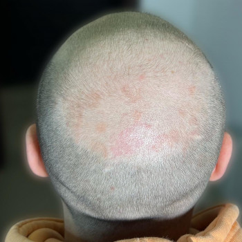 Трихопігментація
                    Мастер перманентного макияжа Ольга Днепр