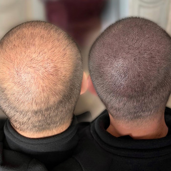 Трихопігментація
                    Мастер перманентного макияжа Ольга Днепр