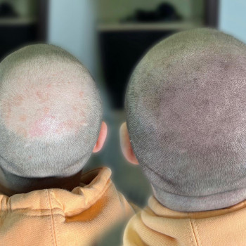 Трихопігментація
                    Мастер перманентного макияжа Ольга Днепр