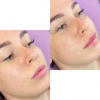 Аугментація губ
                    Косметологический центр Doskonala Ужгород