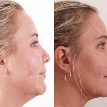 SMAS ліфтинг (BTL, Великобританія, Чехія)
                    Косметологический центр Art clinique Киев