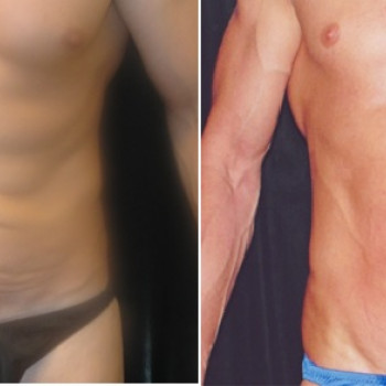 SMAS ліфтинг (BTL, Великобританія, Чехія)
                    Косметологический центр Art clinique Киев