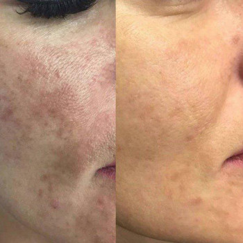 Пілінг PRX-T омолоджуючий
                    Косметологічний центр Art clinique Київ