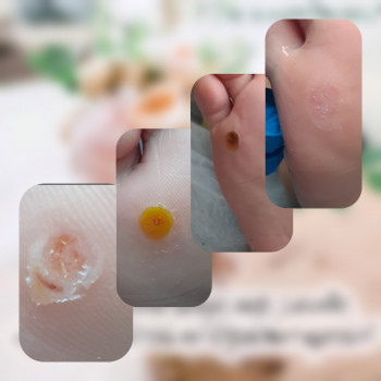 Обробка бородавки