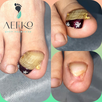 Обробка нігтя при оніхогрифозі