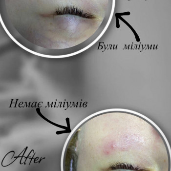 Комбінова чистка. Видалення міліумів.
