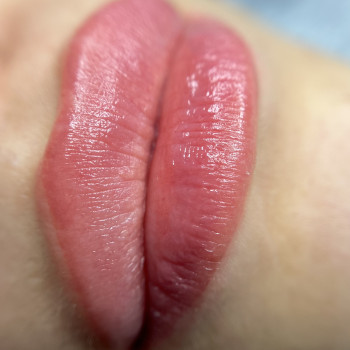 Загоєні губки з гіалуронкою через 1,5 місяці після однієї пр