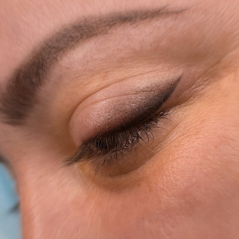 Стрілка з розтушовкою одразу після процедури.