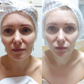 Курс масаж обличчя до та після