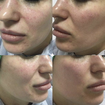 Контурная пластика
                    Дерматолог косметолог Алёна Николаев