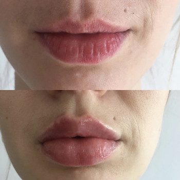 Контурная пластика
                    Дерматолог косметолог Алёна Николаев