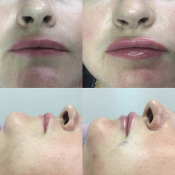 Контурная пластика
                    Дерматолог косметолог Алёна Николаев