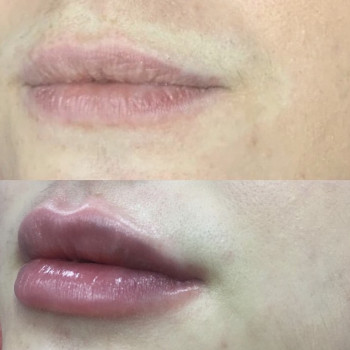 Контурная пластика
                    Дерматолог косметолог Алёна Николаев