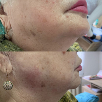 Контурная пластика
                    Дерматолог косметолог Алёна Николаев