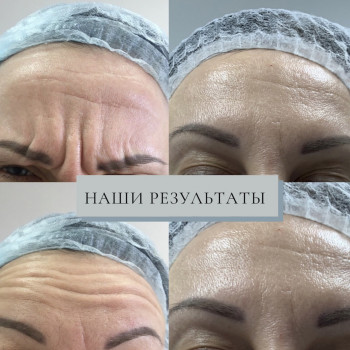 Ботокс, ботулинотерапия
                    Дерматолог косметолог Алёна Николаев
