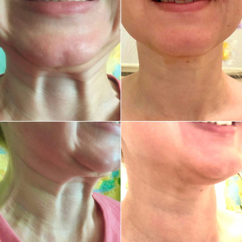 Ботокс, ботулинотерапия
                    Дерматолог косметолог Алёна Николаев