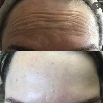 Ботокс, ботулинотерапия
                    Дерматолог косметолог Алёна Николаев