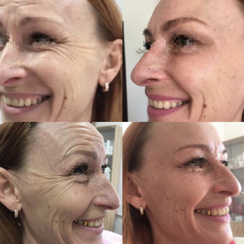 Ботокс, ботулинотерапия
                    Дерматолог косметолог Алёна Николаев