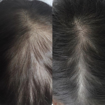 Лечение выпадения волос
                    Дерматолог косметолог Алёна Николаев