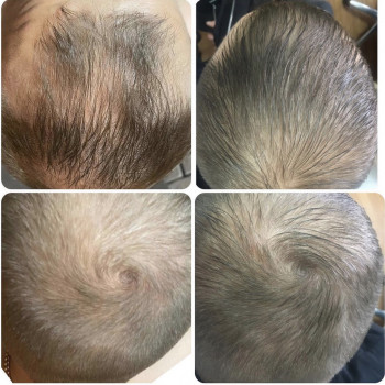 Лечение выпадения волос
                    Дерматолог косметолог Алёна Николаев