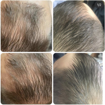 Лечение выпадения волос
                    Дерматолог косметолог Алёна Николаев