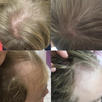 Лечение выпадения волос
                    Дерматолог косметолог Алёна Николаев