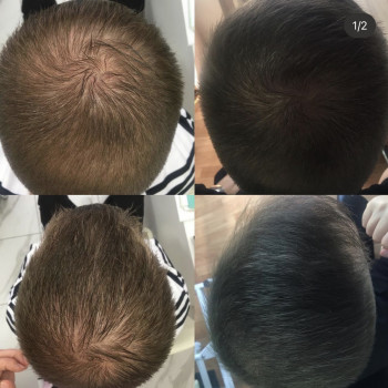 Лечение выпадения волос
                    Дерматолог косметолог Алёна Николаев