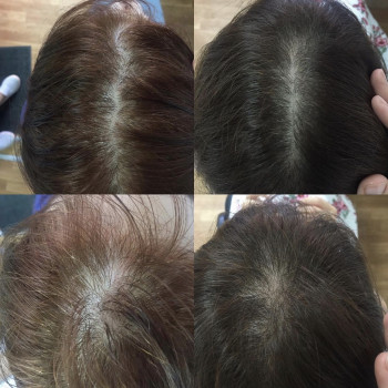 Лечение выпадения волос
                    Дерматолог косметолог Алёна Николаев