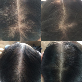 Лечение выпадения волос
                    Дерматолог косметолог Алёна Николаев