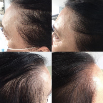 Лечение выпадения волос
                    Дерматолог косметолог Алёна Николаев