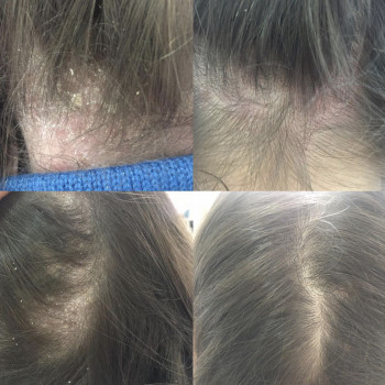 Лечение выпадения волос
                    Дерматолог косметолог Алёна Николаев