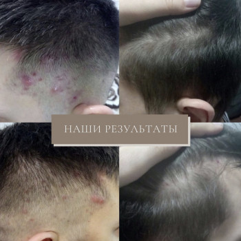 Лечение выпадения волос
                    Дерматолог косметолог Алёна Николаев