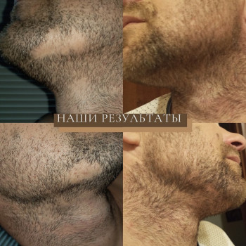 Лечение выпадения волос
                    Дерматолог косметолог Алёна Николаев
