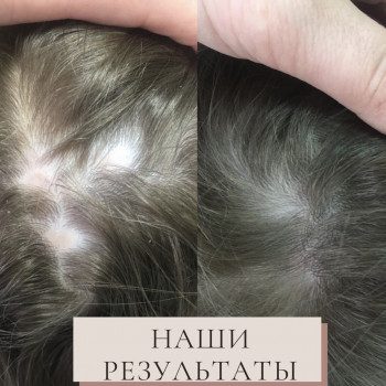 Лечение выпадения волос
                    Дерматолог косметолог Алёна Николаев