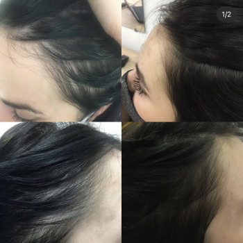 Лечение выпадения волос
                    Дерматолог косметолог Алёна Николаев