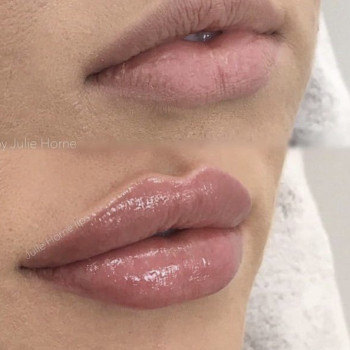 Збільшення обьєму губ
Техніка Бант