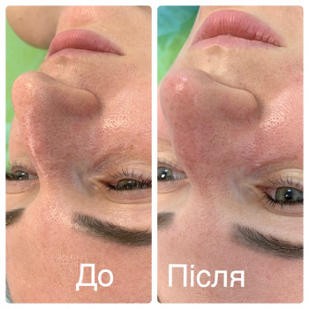 Комбінована чистка обличчя + Хімічний пілінг