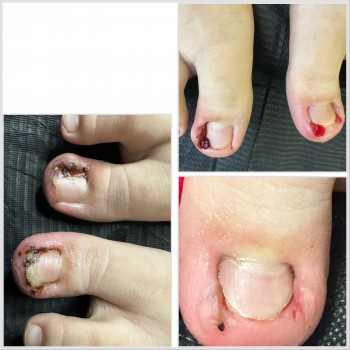 Корекція вирослого нігтя