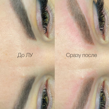 Лазерное удаление татуажа бровей 
До и После процедуры

 