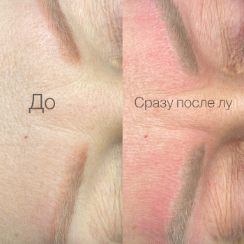 Лазерное удаление татуажа бровей 
До и После процедуры

 