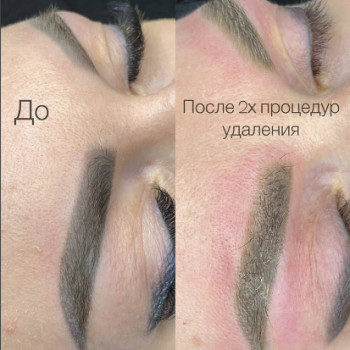 Лазерное удаление татуажа бровей 
До и После процедуры
 