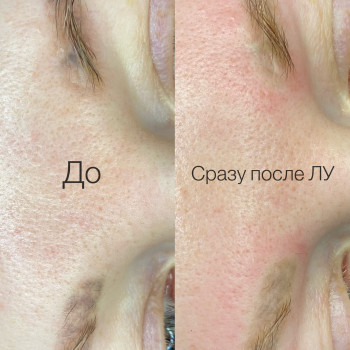 Лазерное удаление татуажа бровей 
До и После процедуры
 