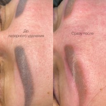 Лазерное удаление татуажа бровей 
До и После процедуры

 