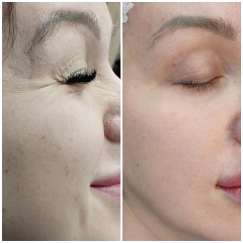 Ботокс мышц вокруг глаз