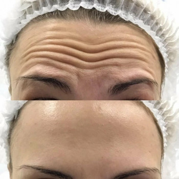 Ботокс лба