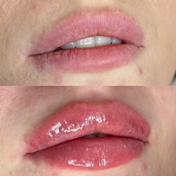 Збільшення губ