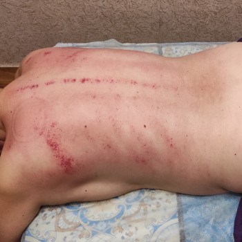 Гуаша спины - снимает воспалительные процессы и нормализует 