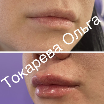 Волюмізація губ