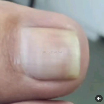 Вросший ніготь
Після