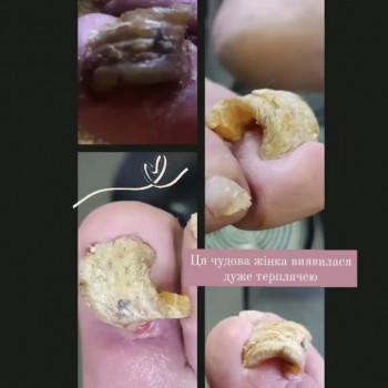 Оніхогрифоз